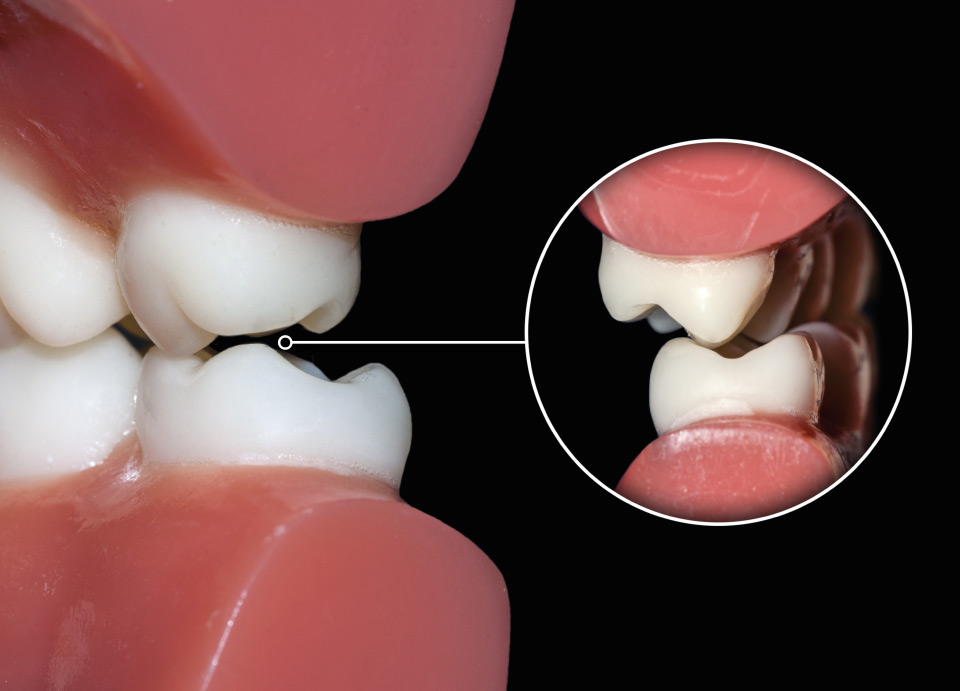 Digrignare i denti di notte | Studio Caberlotto Dentisti