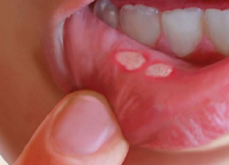 Ulcere orali | Studio Caberlotto Dentisti