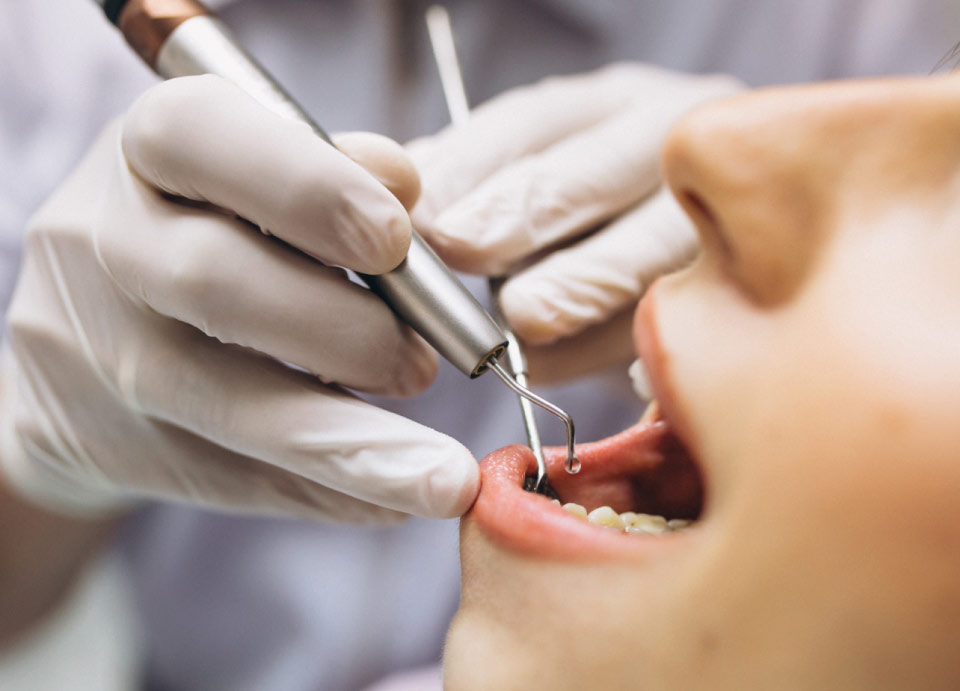 Differenza tra parodontite e gengivite | Studio Caberlotto Dentisti